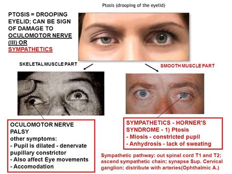 Oculomotor Palsies Google Search Nerve Palsy Drooping Eyelids Spinal Cord Pupil Neuro