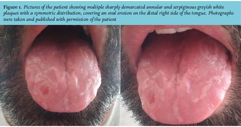 Article A Man With An Unique Tongue Disorder Full Text January