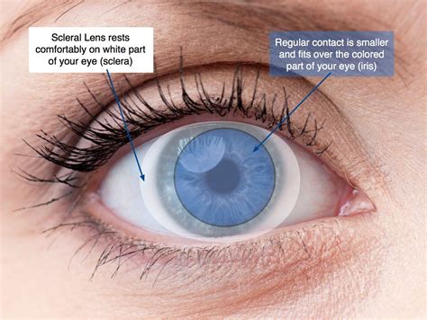 Exploring Scleral Contact Lenses A Comprehensive Guide