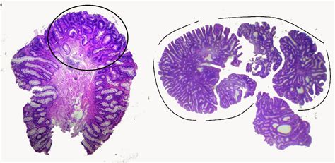 gastrointestinal and liver histology pathology atlas colon adenomas