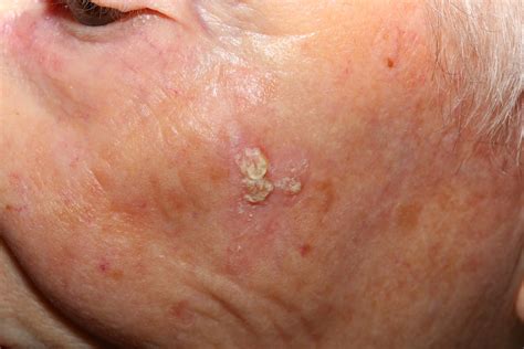 Seborrheic Keratosis Causes Symptoms Home Treatment