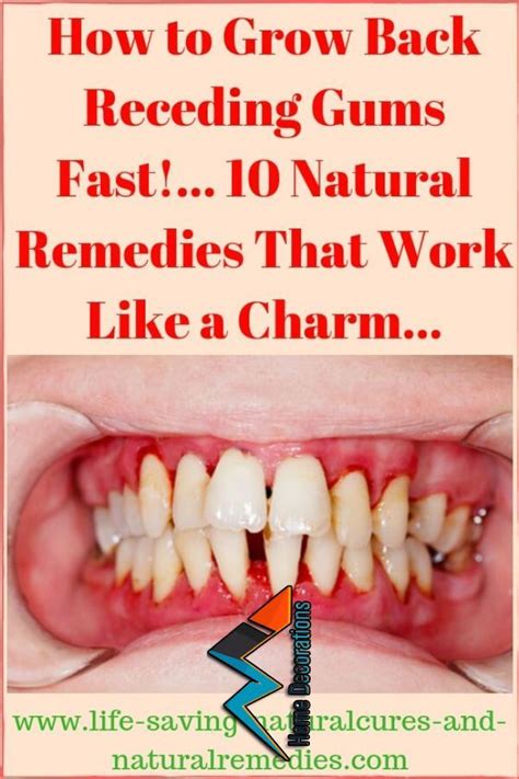 Periodontal disease in dogs (aka gum disease) is a significant health concern. Grow Back Your Receding gums! | Gum disease remedies, Grow ...