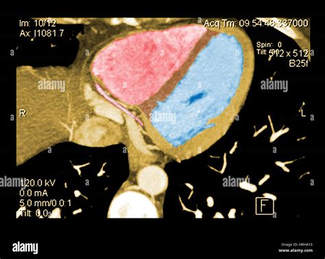 Ct Of Cardiac Chambers Hi Res Stock Photography And Images Alamy
