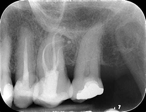 Chronic Apical Periodontitis Kitsilano Endodontics