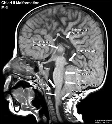 File:Chiari II malformation MRI02.jpg - Embryology