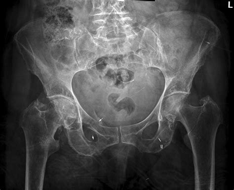 Radiography Of Pubic Rami Fractures Wikiradiography