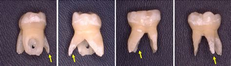 Incidence And Relationship Of An Additional Root In The Mandibular