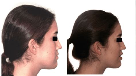 Adult Maxillary Protraction A Case Study Face Pulling Maxilla