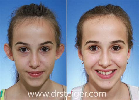Otoplasty Before And After Photos Ear Pinning Boca Raton