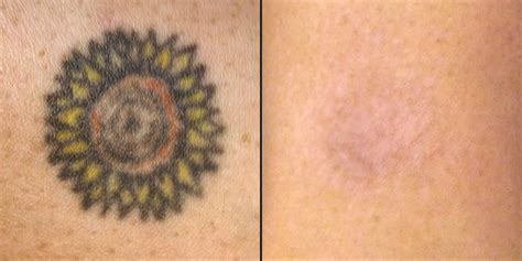 Natural Tattoo Removal: How To Remove Tattoos Naturally?