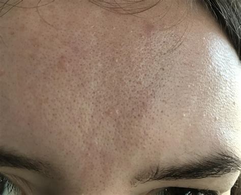 Orange Peel Skin Disaster W Pictures Page 5 General Acne