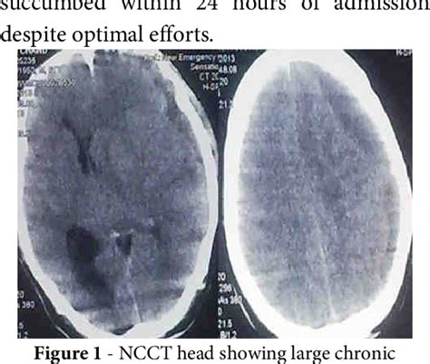 Figure 1 From Chronic Subdural Hematoma Development In Accelerated