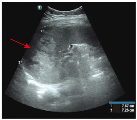 Jcm Free Full Text Splenic Metastatic Choriocarcinoma With