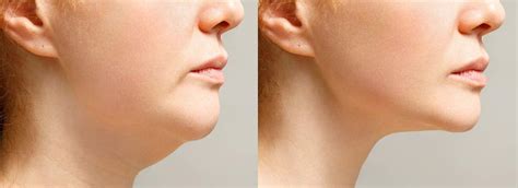 Kybella® San Francisco Reduce Double Chin Dr David W Kim