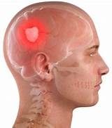 What Are The Side Effects Of Brain Surgery