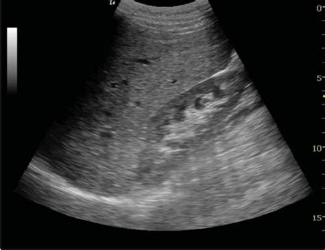 But here is a version from a textbook as it were. Ultrasound Diagnosis of Ectopic Pregnancy (PDF Download ...