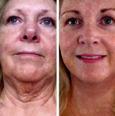 Lifestyle Lift Reviews - All About Style Rhempreendimentos.Com