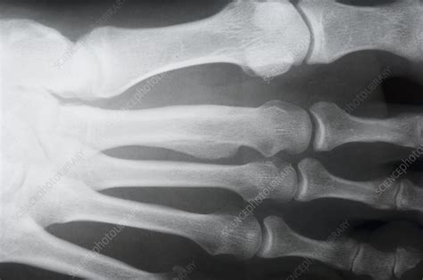 Bone Lump Foot X Ray Stock Image M3301441 Science Photo Library
