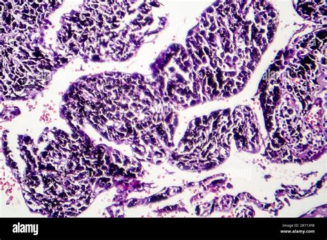 Smokers Lung Histopathology Light Micrograph Showing Accumulation Of