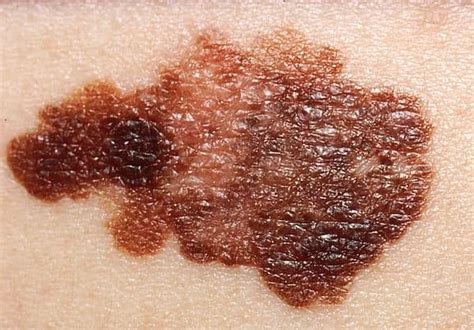 Three Common Types Of Skin Cancers Hubpages