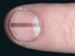 So that we can take prompt action when we see a dark line on nails, and get appropriate. Healt and Other information: 9 Nail Colors Indicate That ...