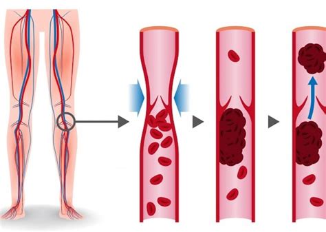 Trombose in de aders komt het meeste voor in de benen, een trombosebeen. Soorten trombose - Trombosestichting