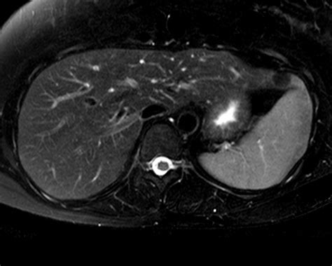 Liver Atlas Diagnosis Angiomyolipoma