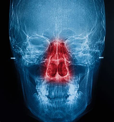 Sinusitis Film X Ray Skull Ap Anterior Posterior Show Infection And Inflammation At