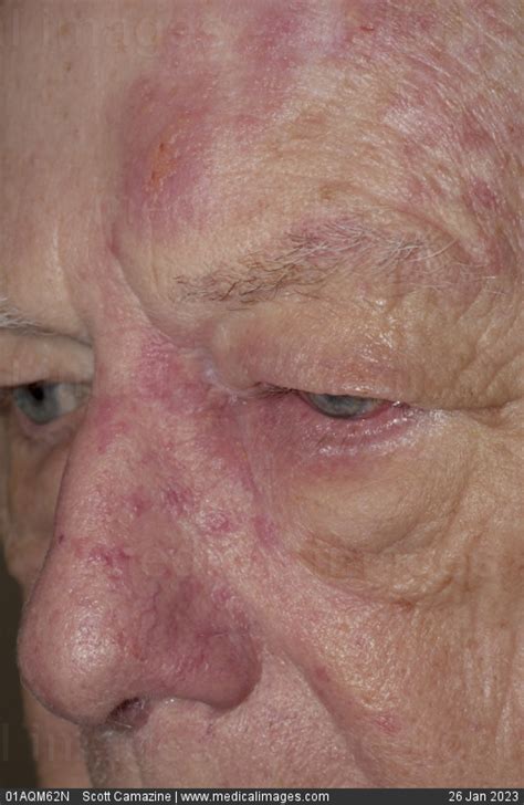 Stock Image A Shingles Rash Herpes Zoster On The Face Of An Elderly