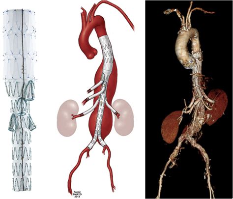 VS1 Endovascular Thoracoabdominal Aortic Aneurysm Repair With T Branch