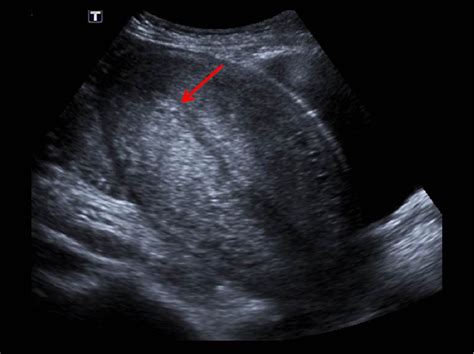 Figure 1 From Imaging In The Postpartum Period Normal Findings Complications And Challenges