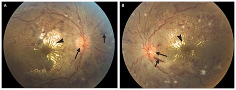 Bilateral Blurred Vision In A “healthy” Adult Nejm