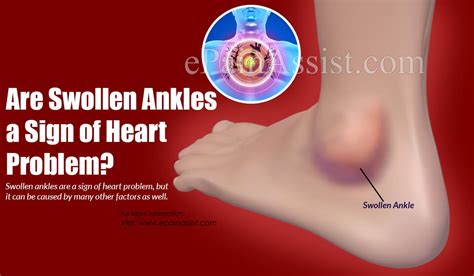 are swollen ankles a sign of heart problem