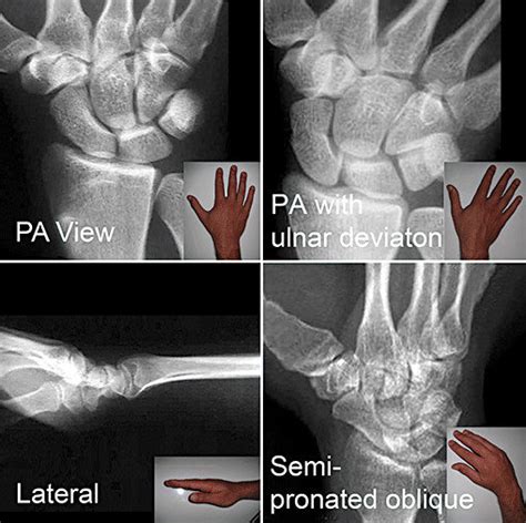 Standard Recommended Scaphoid X Ray Views Postero