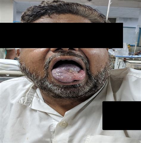 Massive Engorgement Of A Hemangioma Of The Tongue After Gene Aanda