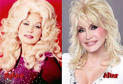 dolly parton plastic surgery gracefully getting old or not plastic surgery mistakes