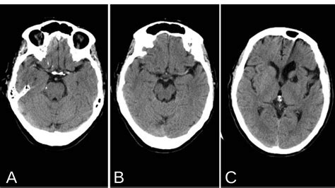 Left Mca Infarct With Hyperdense Mca Sign