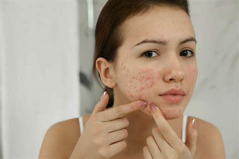 6 Different Types Of Acne Scars And How To Treat Them Scar Makeup To