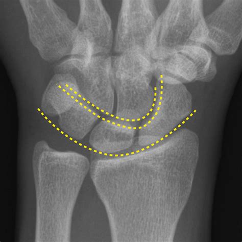 Wrist Annotated X Rays Image