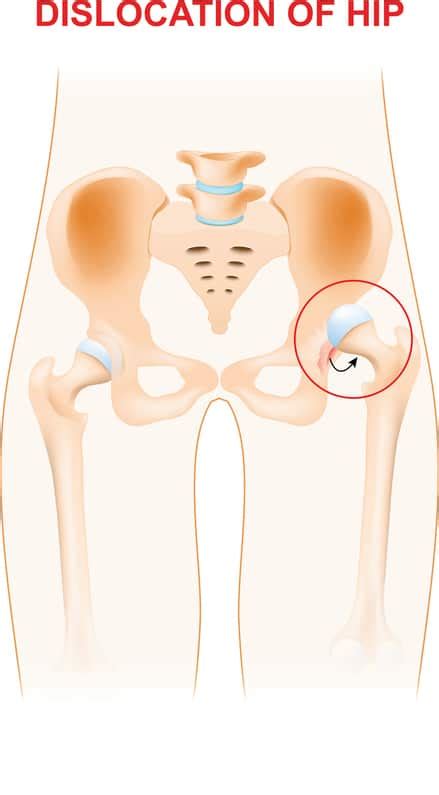 What To Do If Youve Dislocated Your Hip Colorado Center Of