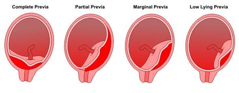 Ismail k.i., hannigan a., kelehan p., fitzgerald b., o'donoghue k., cotter a. Placenta previa: Causas, Sintomas y Tratamiento | MD ...