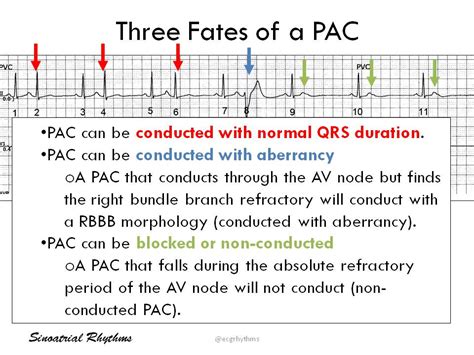 The Fates Of A Premature Atrial Complex Pac Can Grepmed