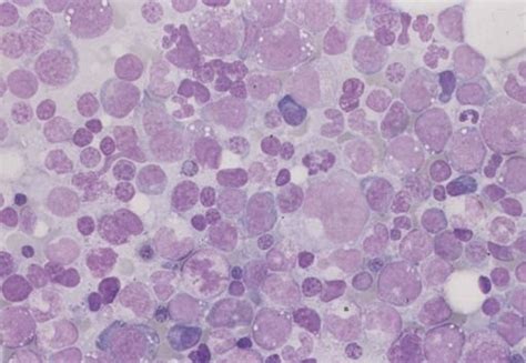 Neutrophil Abnormalities In Mds Fig1 Bone Marrow Picture Of A Patient