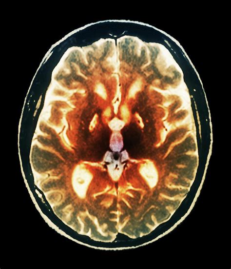 Anoxia Brain Damage Photograph By Zephyrscience Photo Library
