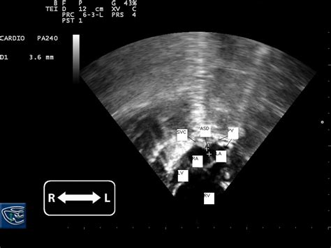 Transthoracic Echocardiography Subcostal Four Chamber Views Note