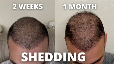 One Month Hair Transplant Update 4 000 Grafts 9K Total Via FUE Dr