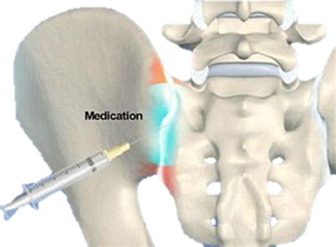 Sacroiliac Joint Pain Rehab On The Road