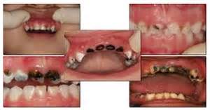 .botol susu (dot) terhadap kejadian rampan karies pada anak prasekolah di kelurahan pabelan. Karies botol susu | teeth&tooth