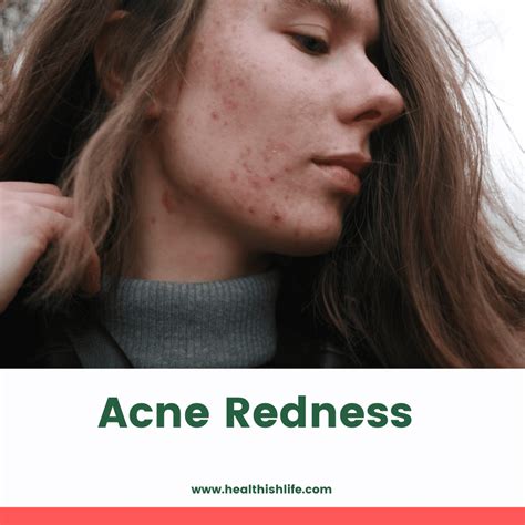 Acne Redness Causes Treatment And Prevention Healthishlife