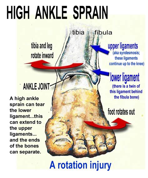 High Ankle Sprain